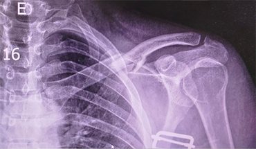 Fratura da Clavícula